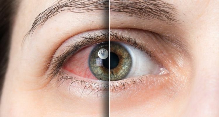 Zespół suchego oka objawy i leczenie