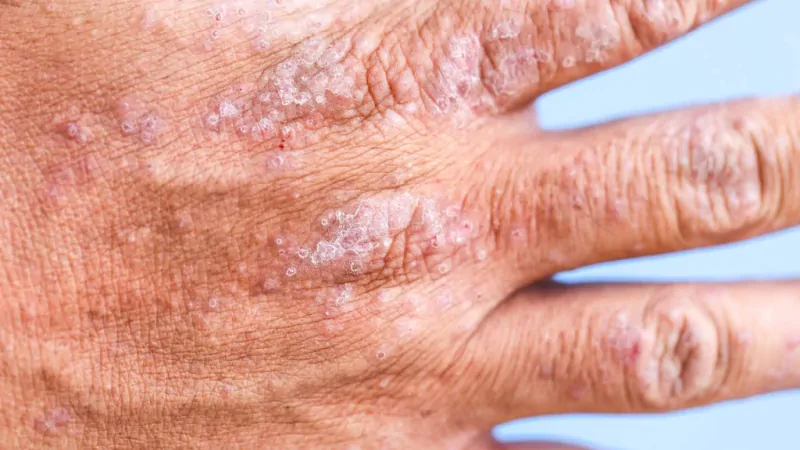 Atopowe zapalenie skóry (AZS) objawy i leczenie